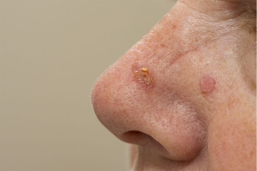 Removal of Actinic Keratoses