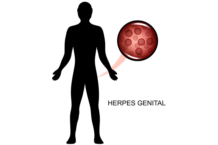 Genital Ηerpes